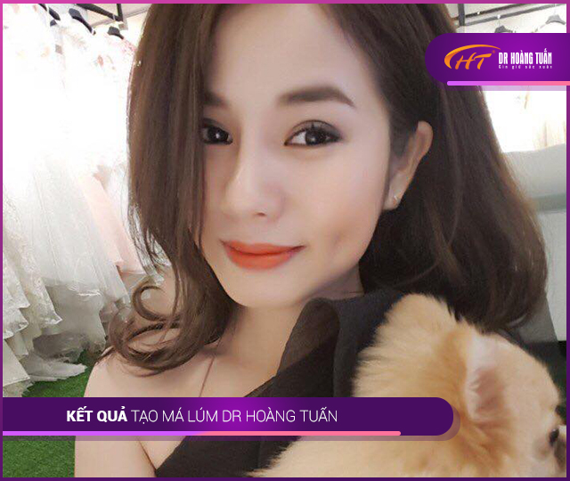 Tạo má lúm đồng tiền tự nhiên đang là xu hướng làm đẹp giúp chị em có được nụ cười duyên dáng